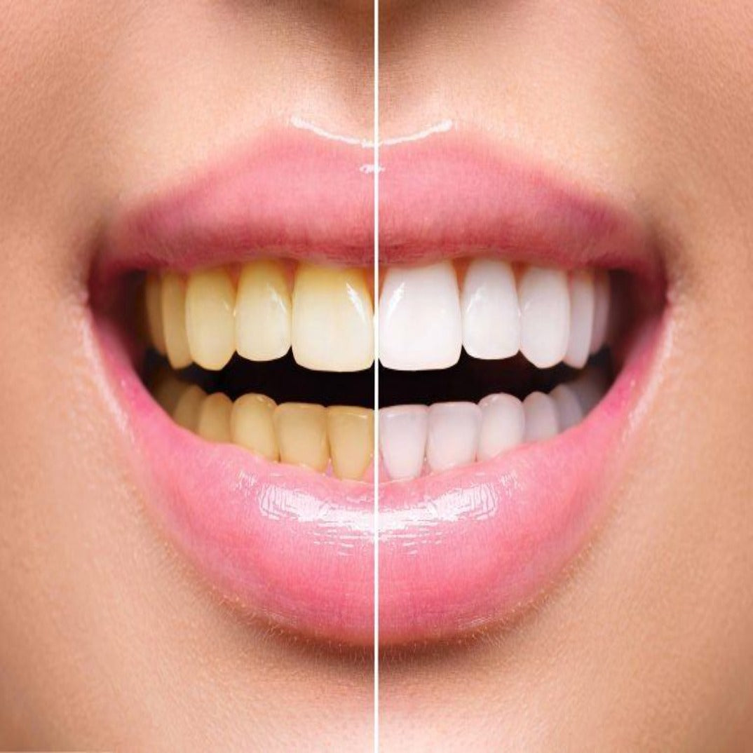 Teeth Whitening Training